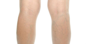 Varicose veins