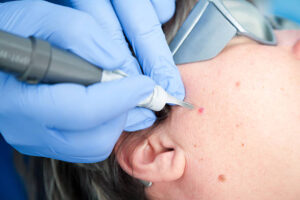 age spots removal by laser treatment .