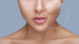 scar removal treatment