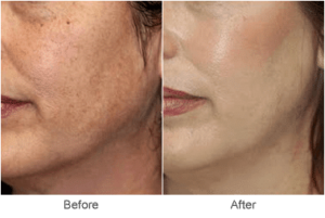 Laser Skin Rejuvenation