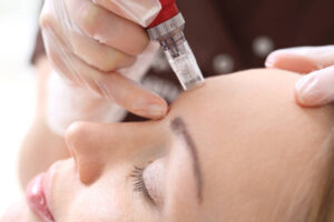 rf microneedling