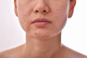 dark spots on skin