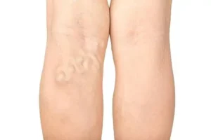 natural remedies help treat varicose veins