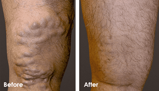 Laser Vein Treatment Before and After