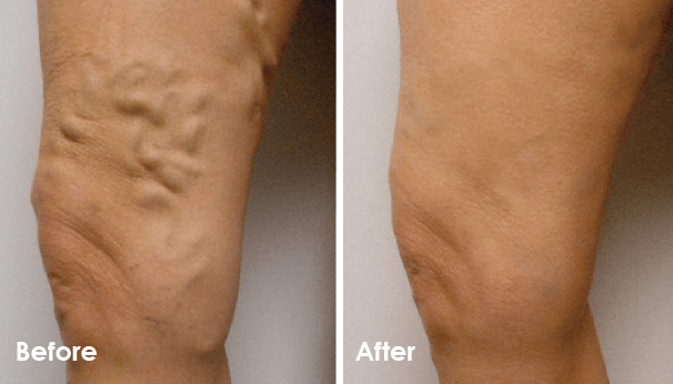 Before and After for Vein Treatment