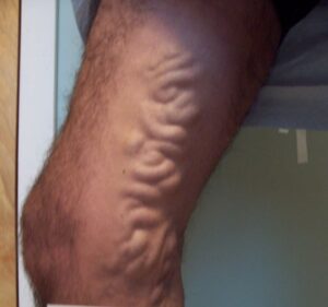 varicose veins