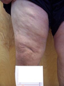 vericose veins removal