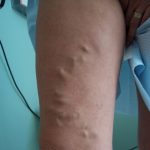 PC before - Vein Removal