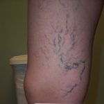 RV before sclerotherapy