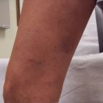 PC 3 weeks after laser and phlebectomies - Vein Removal