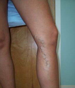 varicose vein removal