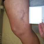 Sclerotherapy treatment