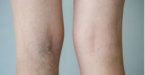 how to get rid of spider veins