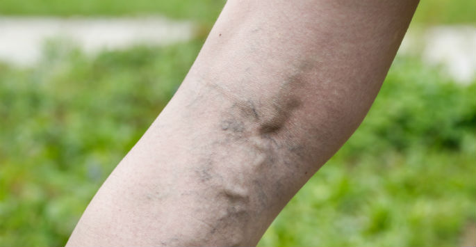 spider & varicose veins