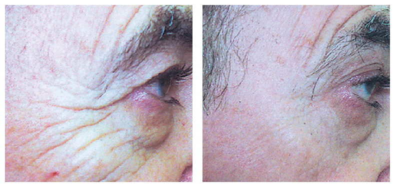 Skin Rejuvenation Treatment | Fox Vein & Laser Experts