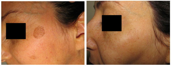 skin rejuvenation