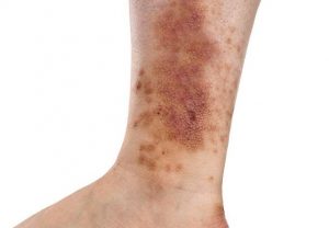 black marks on legs