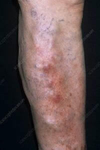 Thrombophlebitis