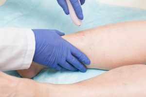 laser treatments for sclerotherapy