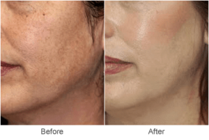 Laser Skin Rejuvenation