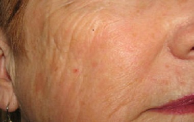 Scar removal