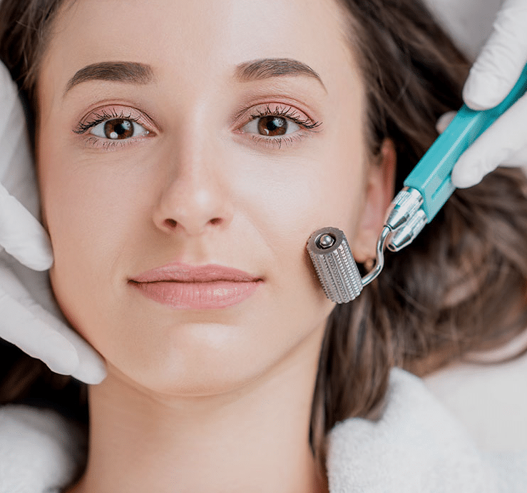 Laser Treatments or Microneedling