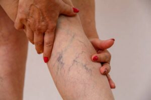 varicose veins treatment