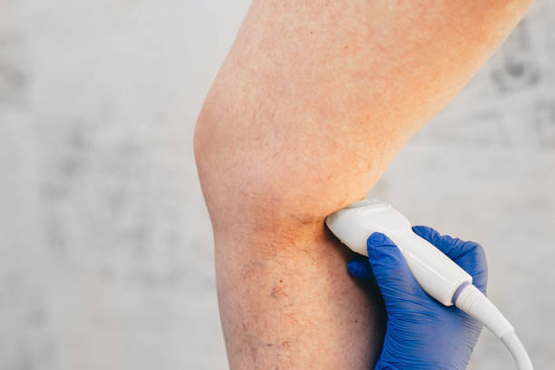 vein doctor treating varicose veins