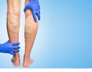 chronic venous insufficiency