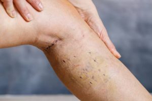 endovenous laser ablation for varicose veins