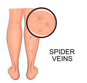 How to Treat Spider Veins
