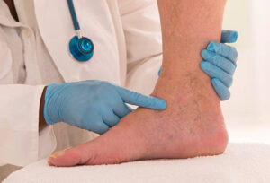 spider veins treatment