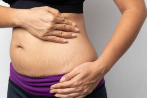 Is There A Way To Tone Your Tummy? - Fox Vein & Laser Experts I