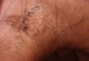 Varicose Veins