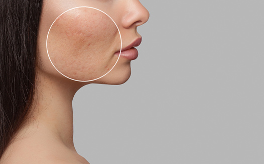 Remove Scars From Face Permanently