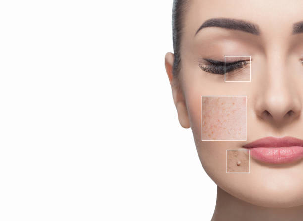 dark spots removal