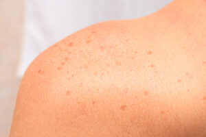 dark spots on skin