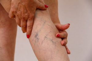 laser vein treatment for elderly