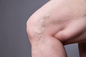 varicose vein treatment for elderly