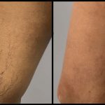 Knee Before and After Surgery
