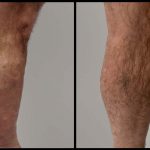 Picture of Legs with Varicose Viens