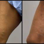 After Sclerotherapy Treatment
