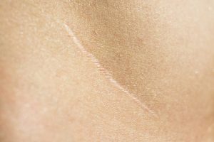 Dermatologist Remove a Scar
