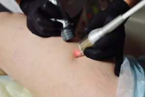 laser vein treatment