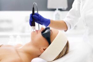 laser hair removal