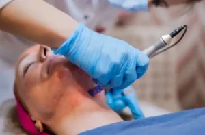 microneedling treatment