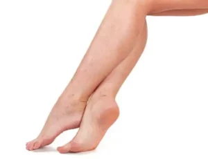 Varicose Veins Care for Nurses