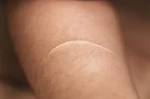 keloid scar removal