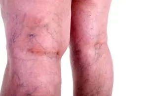 natural remedies for varicose veins