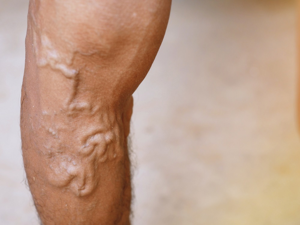 Does Medicaid Cover Varicose Vein Treatment